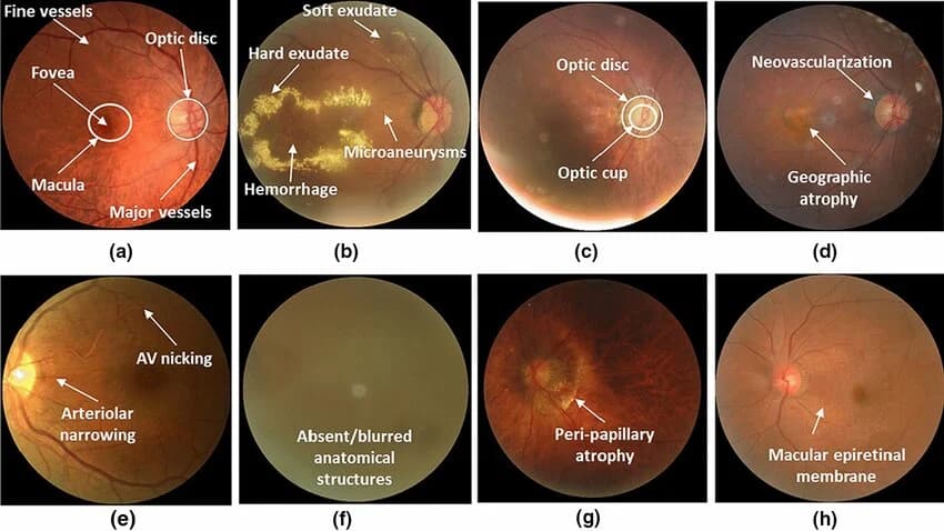Eye Disease Detection System